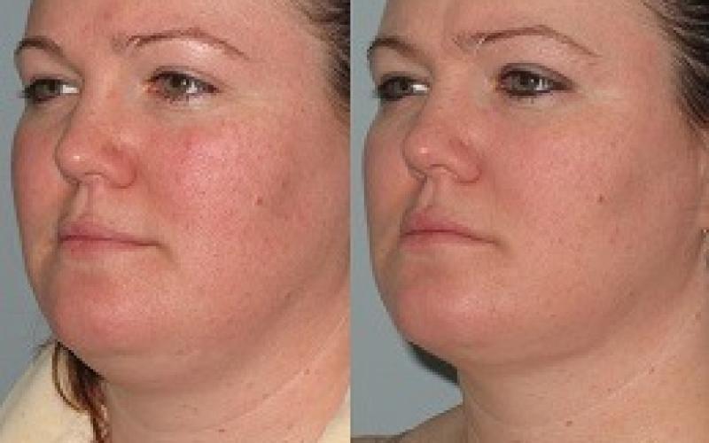 Safe Double Chin Removal in Dubai With Modern Techniques